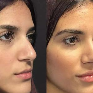 Best Septoplasty Surgeons in Dubai Offering Advanced 3D Imaging Best Septoplasty Surgeons in Dubai Offering Advanced 3D Imaging