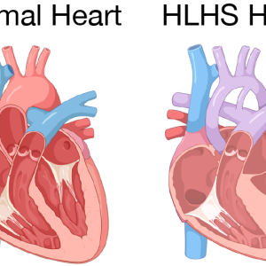 Hypoplastic Left Heart Syndrome Market Analysis, Epidemiology  Forecast till 2024-2034
