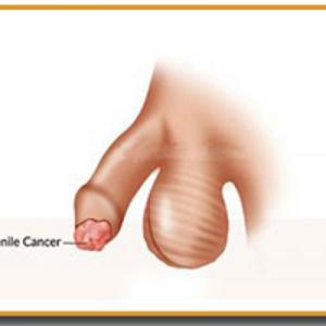 Penile Cancer Market Research | 2024-2034