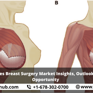 United States Breast Surgery Market Insights, Outlooks, Growth, Opportunity