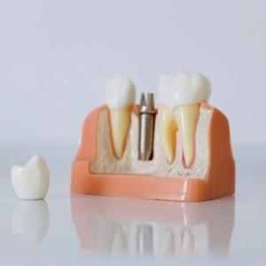 Thinking About a Front Tooth Implant? Here’s What You Need to Know Thinking About a Front Tooth Implant? Here’s What You Need to Know