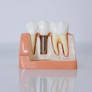 The Role of 3D Imaging in Dental Implant Planning