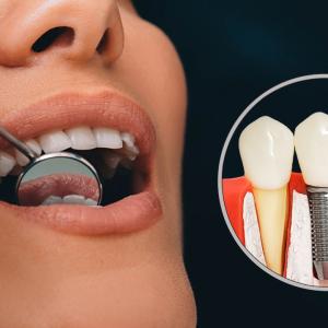 Dental Implants and Senior Citizens: Implant Solutions for Aging Adults