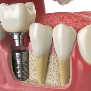 Dental Implants and Wearable Devices: Monitoring Progress