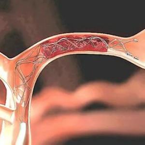Mechanical Thrombectomy Devices Market significant Growth factors 2022-2028| Research Informatic