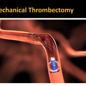 Mechanical Thrombectomy Devices Market 2022-2025 Global Industry Size