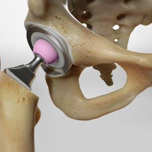 Hip Replacement Market Size, Growth, Industry Trends, Analysis and Forecast 2024-2032