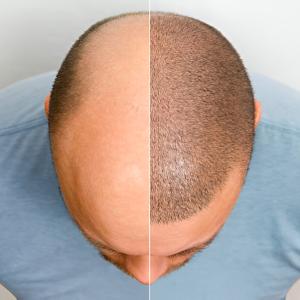 Why More Young Men Are Choosing Hair Transplants?