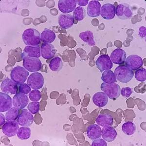 Acute Myeloid Leukemia (AML) Market Size, Trends, and Growth Opportunities 2026-2033