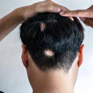 Global Alopecia Areata Treatment Market: Size, Trends, and Growth Analysis