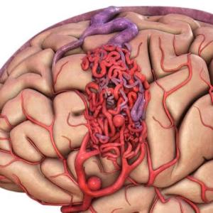 Arteriovenous Malformations Market: Size, Trends, and Strategic Growth Insights