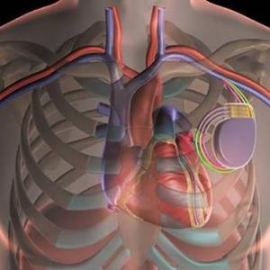 Global Cardiac Resynchronization Therapy Market Size, Trends, and Growth Outlook 2026-2033