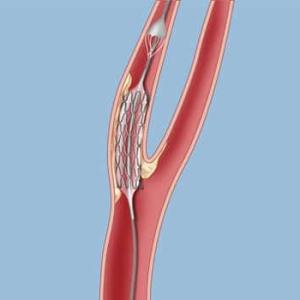 Global Carotid Artery Stent Market: Size, Trends, and Growth Dynamics (2026–2033)