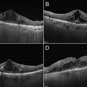 Diabetic Macular Edema Market Size, Trends, and Growth Forecast 2026-2033