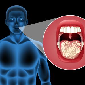 Salivary Gland Infection Market Size, Trends, and Growth Analysis 2026-2033