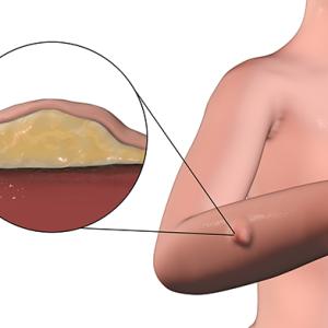 Soft Tissue Sarcoma Market Size, Trends, Growth Drivers, and Forecast 2026–2033