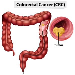 U.S. Colorectal Cancer Screening Market Size, Trends, and Growth Forecast