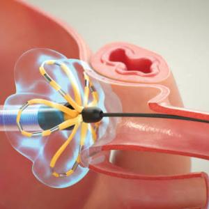 Pulsed Field Ablation Market: Size, Trends, Revenue, and Growth Opportunities