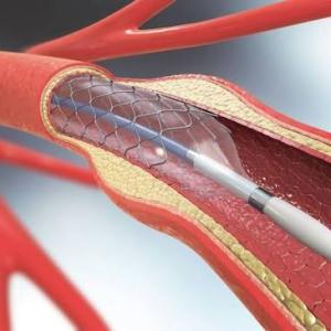 Cardiovascular Stents Market Size, Trends, and Growth Outlook 2026-2033