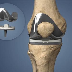 Knee Implants Market Size, Trends, Revenue, and Growth Analysis 2026-2033
