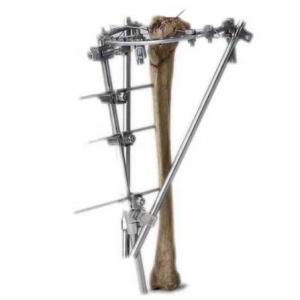 Orthopedic Trauma Devices Market Growth and Opportunities (2026-2033)