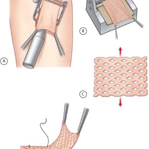 Skin Replacement Market: Size, Trends, and Growth Opportunities 2026-2033