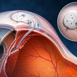 Global Glaucoma Drainage Devices Market Size, Trends, and Growth Analysis