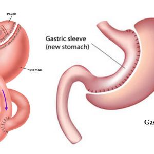 best bariatric surgery