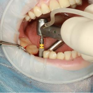 Comparing Single-Tooth Implants and All-on-4 Solutions
