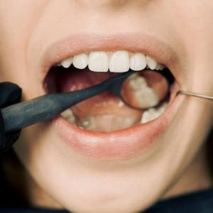 Financing Options for Dental Implants: What You Should Know