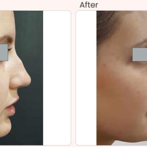 Cost and Recovery After Rhinoplasty