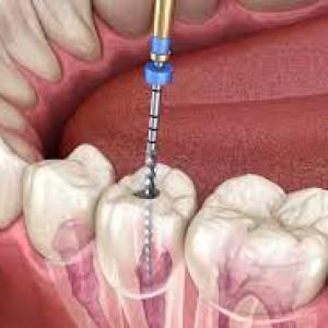 How is a root canal performed and what are the steps involved in RCT?