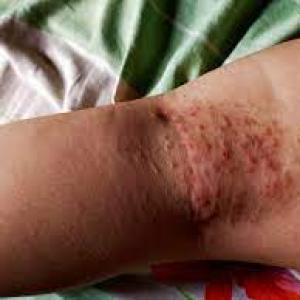 Unleash the Power of Mupirocin for Bacterial Skin Infections