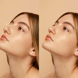 Things You Need to Know About Jawline Fillers