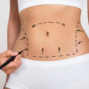 How Soon Can I Exercise After Liposuction in Dubai