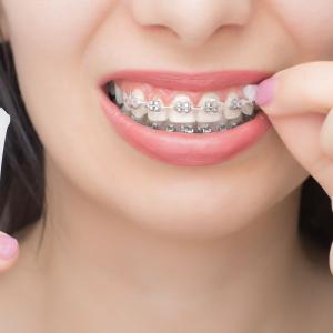 The Role of Orthodontic Wax in Relieving Braces Discomfort