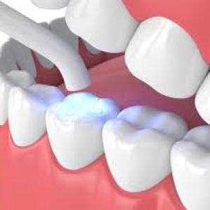 The Benefits of Tooth-Colored Fillings Over Traditional Amalgam Fillings