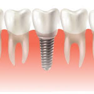 Dental Implants and Acupuncture: Complementary Pain Relief Methods