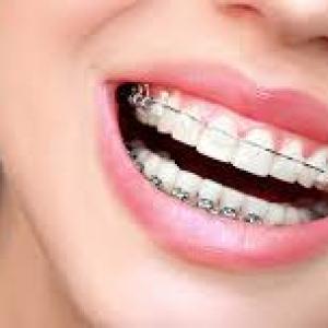 Are Clear Braces Worth the Extra Cost?