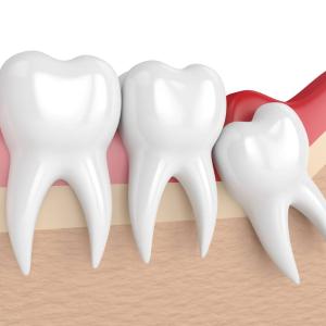 Can You Keep Your Wisdom Teeth and Still Have a Healthy Mouth?
