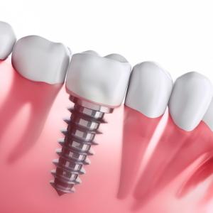 Dental Implants and TMJ Disorders: Impact and Solutions