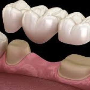 Fixed Teeth in a Day for Edentulous Patients: Benefits and Considerations