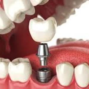 How to Care for Your Dental Implants: Tips for Long-Lasting Results