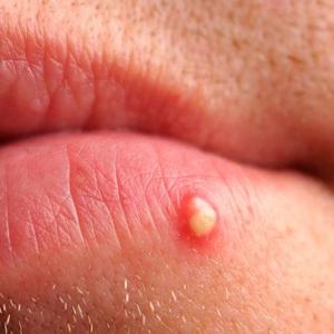 Anal herpes: These remedies will come in handy to avoid these troublesome problems