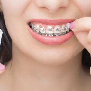 Orthodontic Supplies Market Snapshot Analysis and Increasing Global Growth 2027