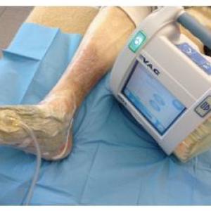 Negative Pressure Wound Therapy Market Size Worth USD 4 billion at a XX% CAGR between 2019- 2027
