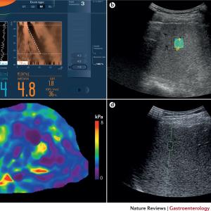 Elastography Imaging Market MRFR Reveals Covid-19 Analysis for 2021-2027