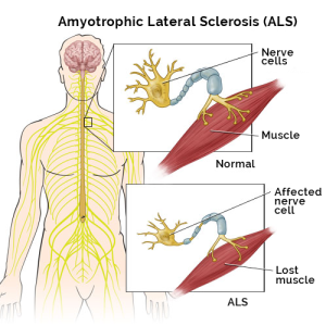 Amyotrophic Lateral Sclerosis Market Business Opportunity, Future Scope & Rising Demand 2027