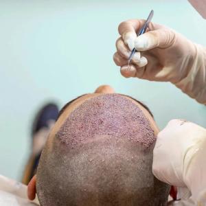 Female Hair Transplant: Restoring Confidence and Natural Beauty