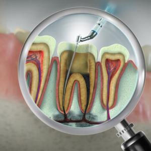 What Happens If You Delay Root Canal Treatment?
